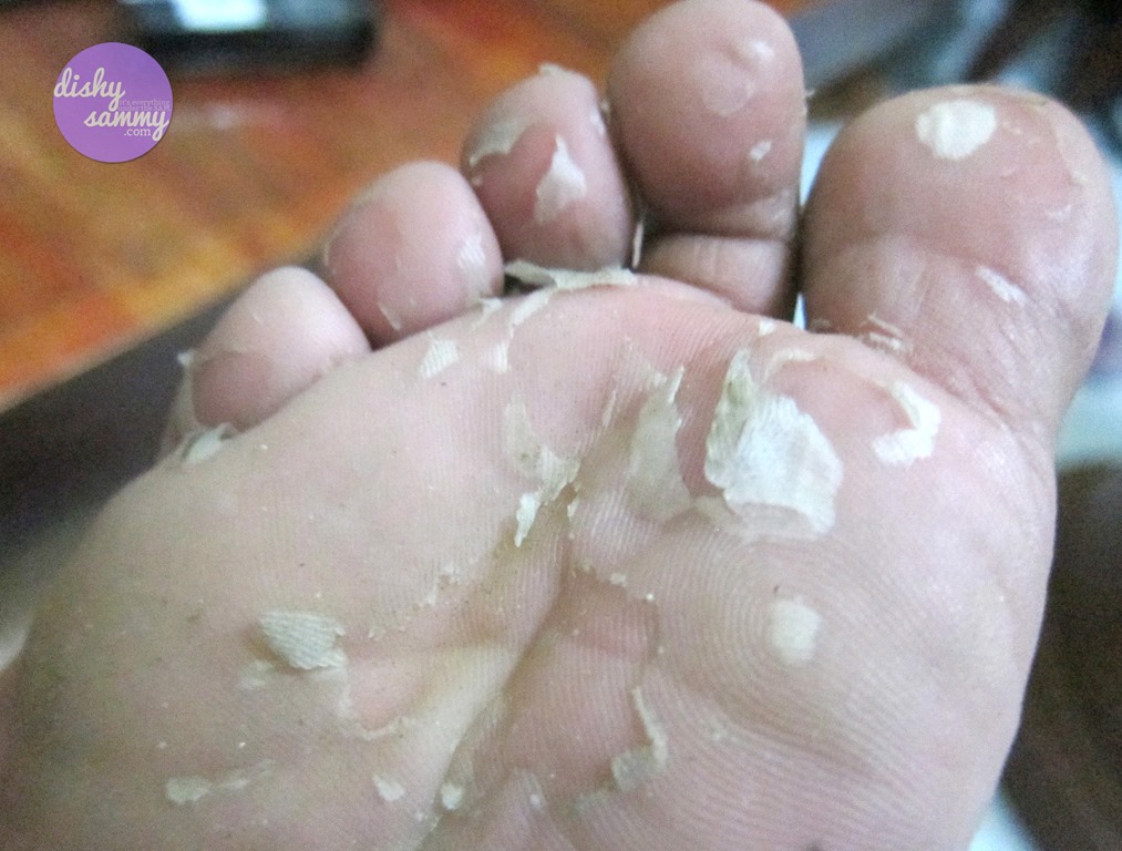 peeling hands and feet #9
